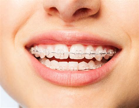 Brackets transparentes: tipos, ventajas y consejos de limpieza